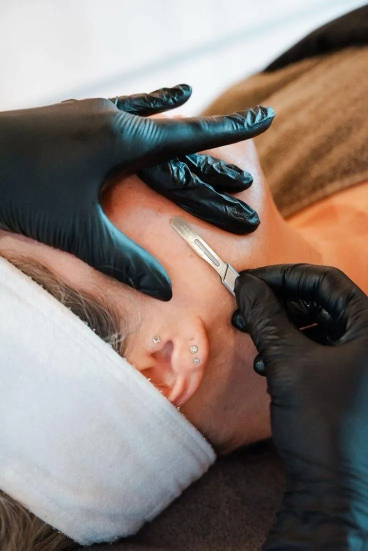 Tratamento de dermaplaning